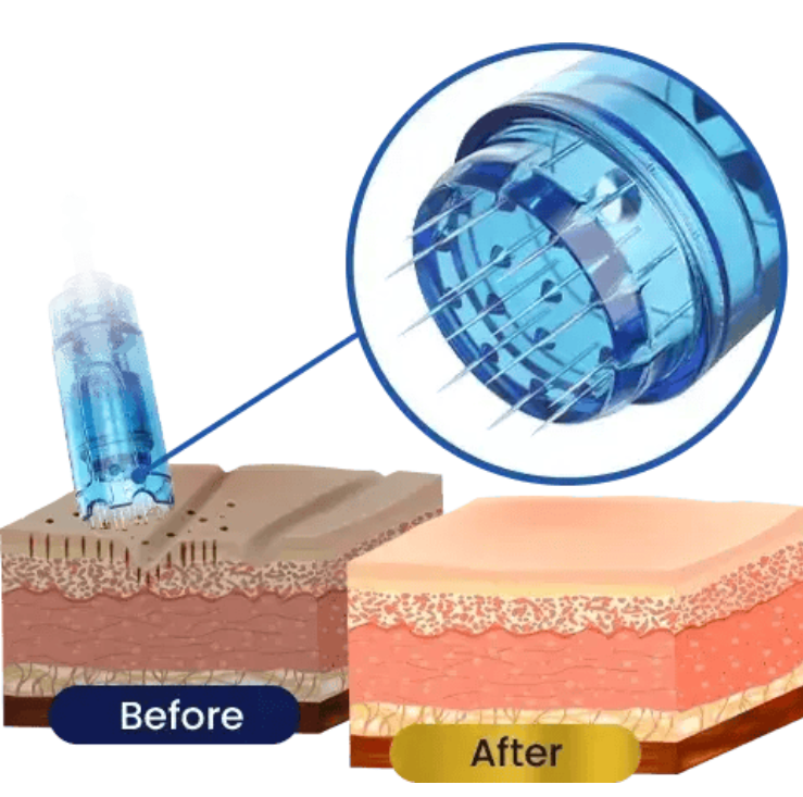 Microneedling for acne treatment