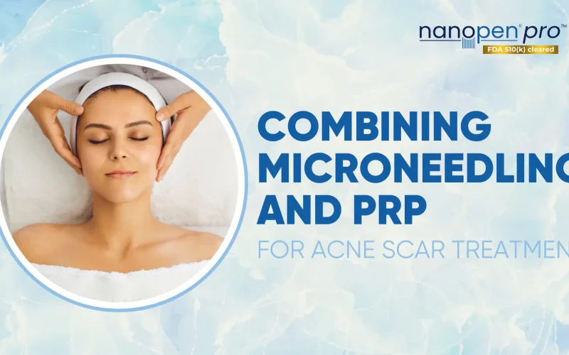 Combining-Microneedling-and-PRP-for-Acne-Scar-Treatment