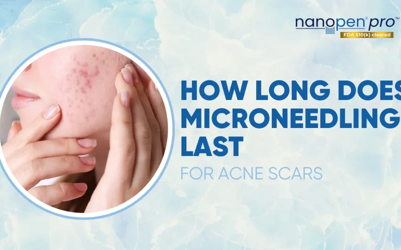 How-Long-Does-Microneedling-Last-for-Acne-Scars