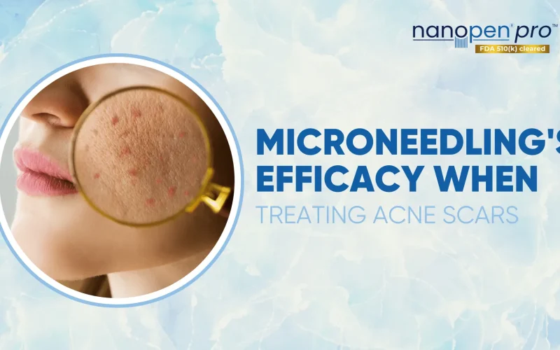 Microneedlings-Efficacy-When-Treating-Acne-Scars
