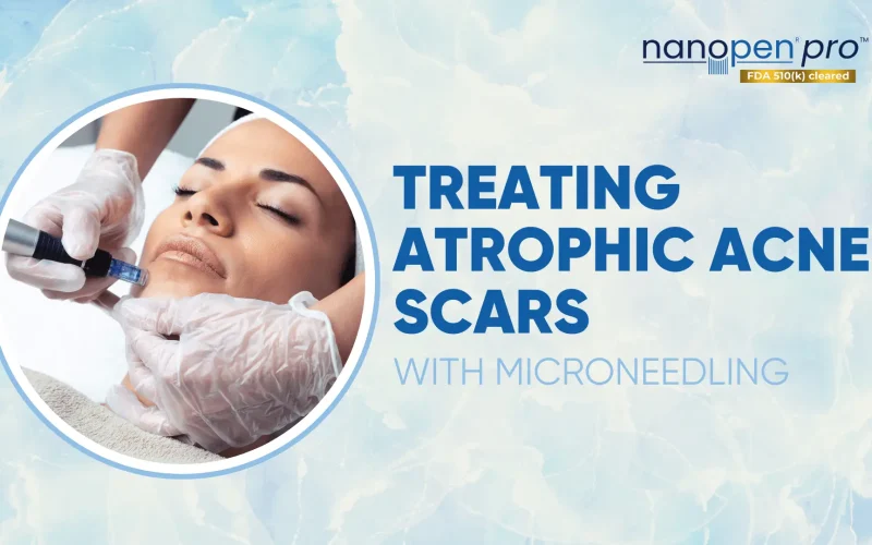 Treating-Atrophic-Acne-Scars-with-MicroNeedling
